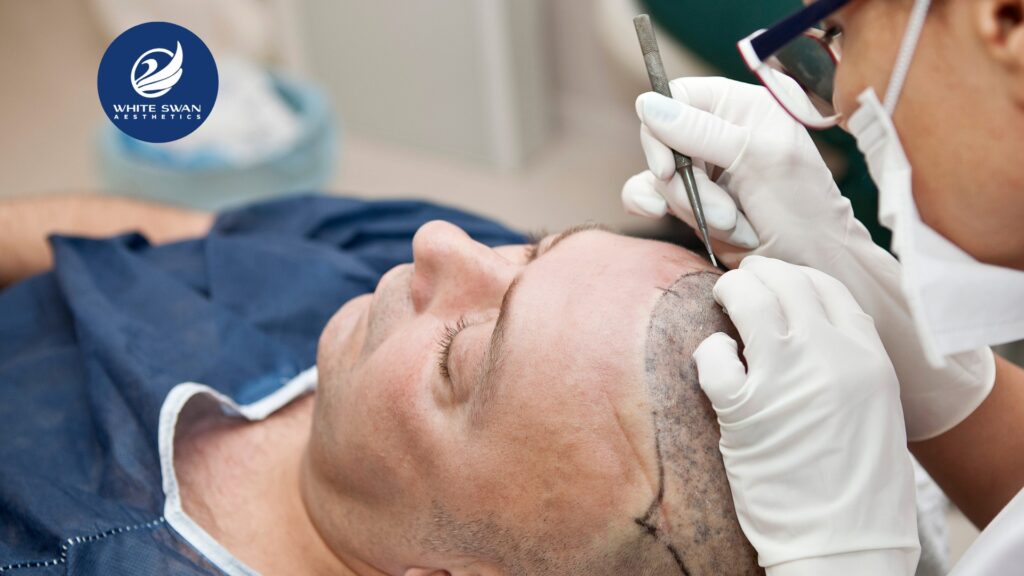 Hair Transplantation Near Me