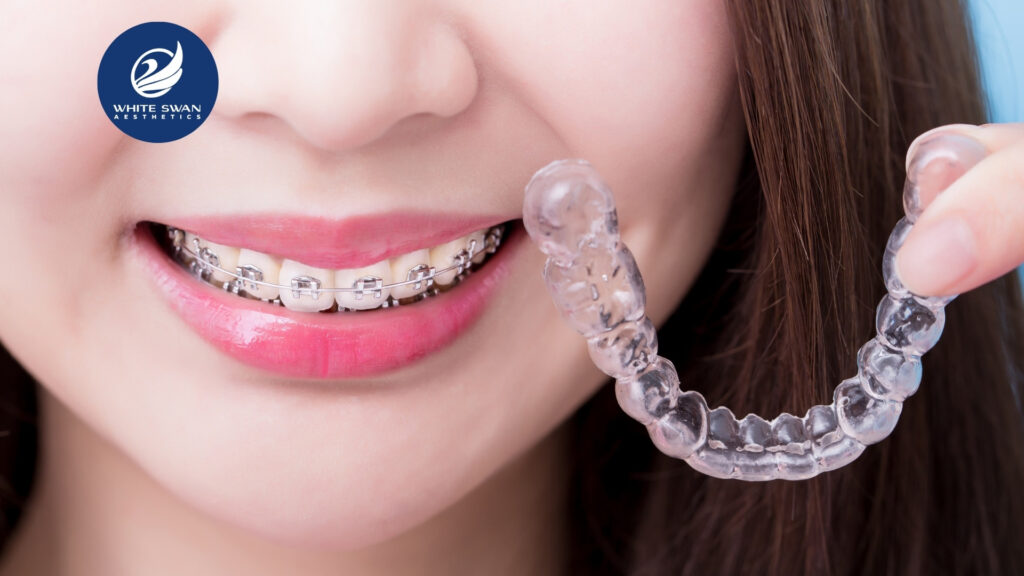 Invisible dental braces