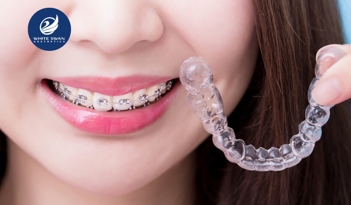 Invisible dental braces