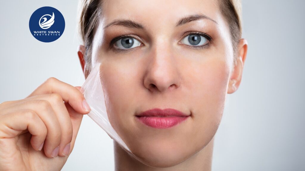 chemical peel for pigmentation