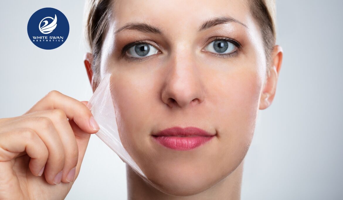 chemical peel for pigmentation