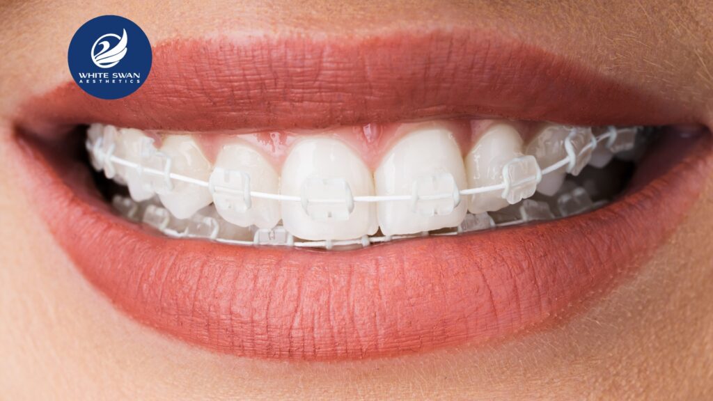 ceramic braces