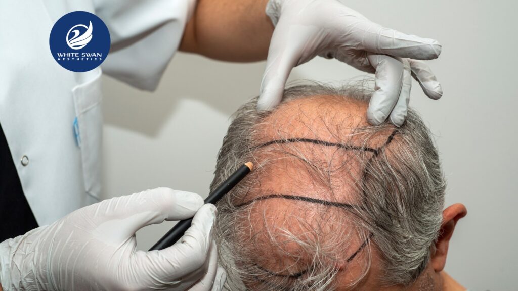 hair transplant doctor