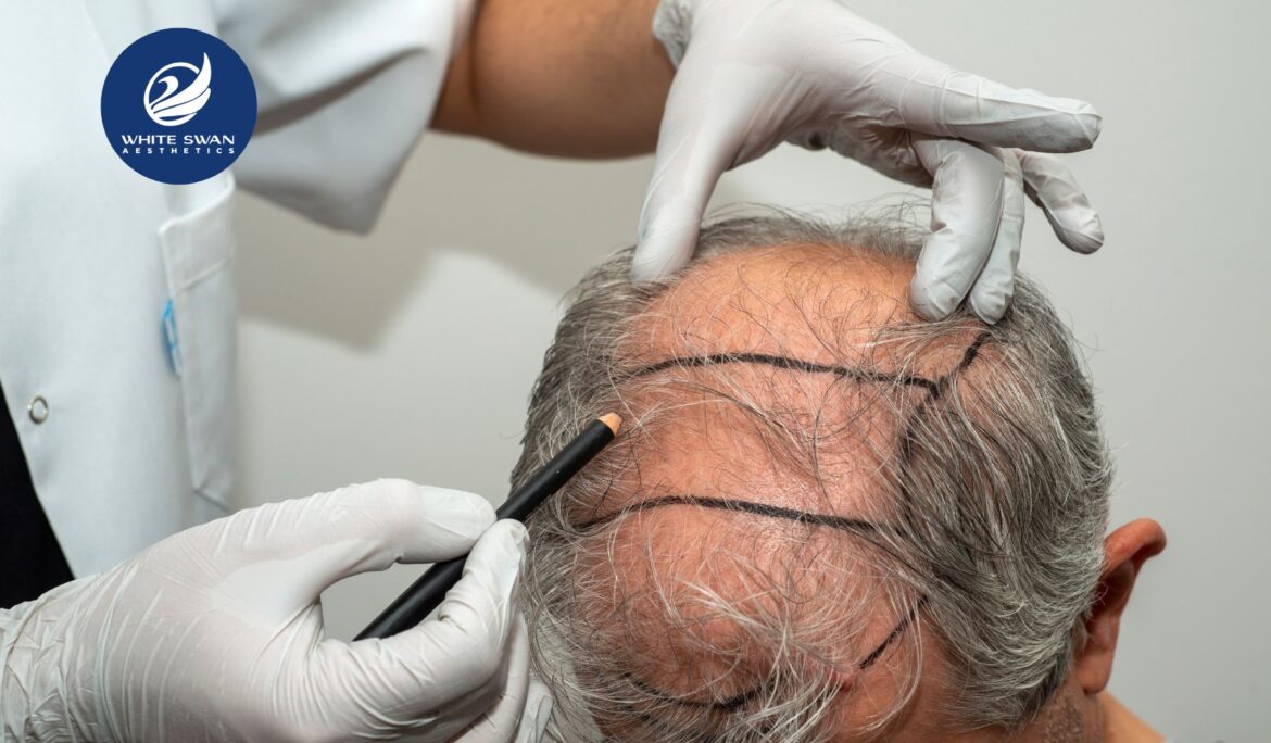 hair transplant doctor