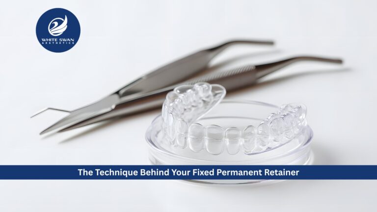 permanent retainer