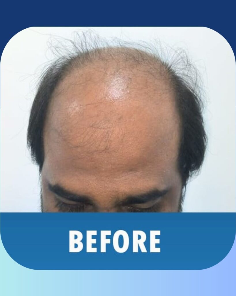 At White Swan Aesthetics, hair transplant