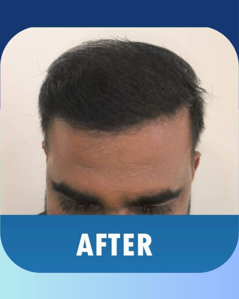 At White Swan Aesthetics, hair transplant