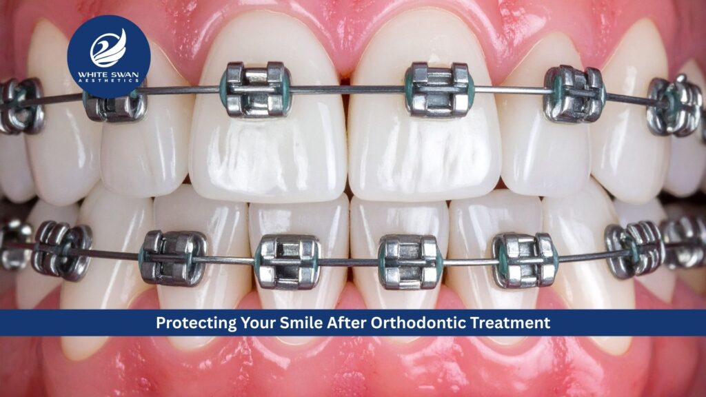 Protecting Your Smile After Orthodontic Treatment