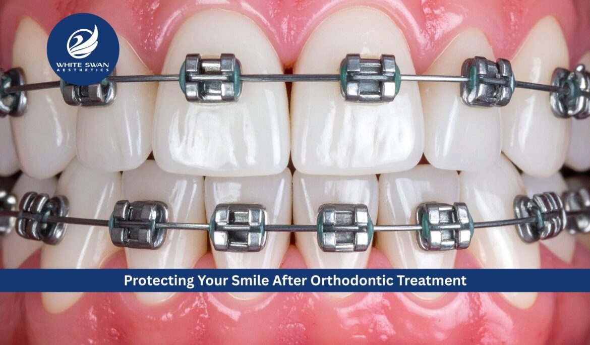 Protecting Your Smile After Orthodontic Treatment