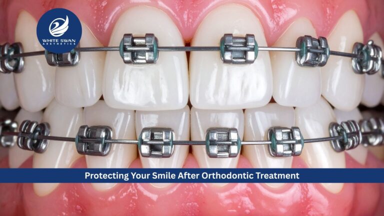 Protecting Your Smile After Orthodontic Treatment
