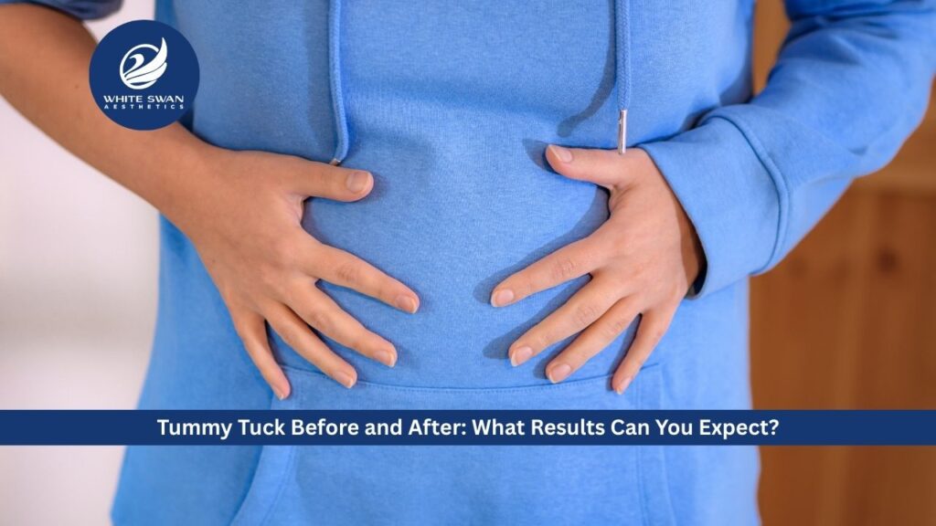 Tummy Tuck Before and After: What Results Can You Expect?