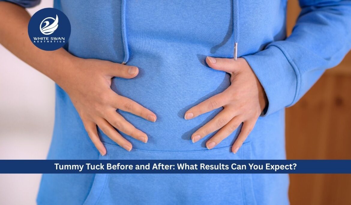 Tummy Tuck Before and After: What Results Can You Expect?