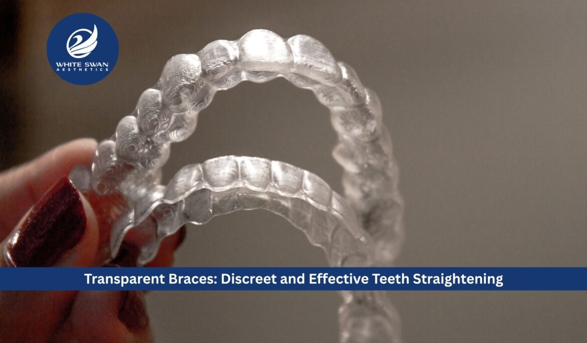 Transparent Braces: Discreet and Effective Teeth Straightening