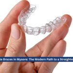 Invisible Braces in Mysore: The Modern Path to a Straighter Smile