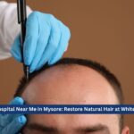 Hair Transplant Hospital Near Me in Mysore: Restore Natural Hair at White Swan Aesthetics